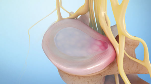 UNIKA Medical Centre | Minimally Invasive Spine Treatments
