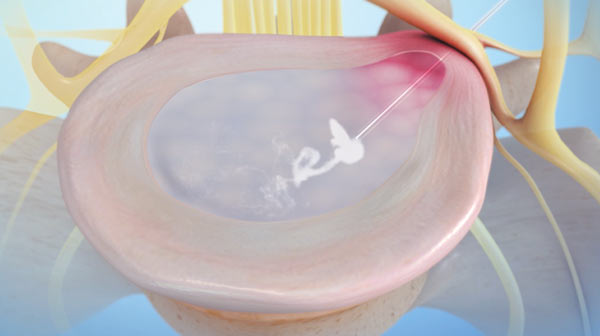 Intradiscal Ozone Therapy - How it works