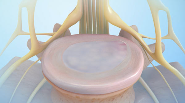 Intradiscal Ozone Therapy - After Treatment