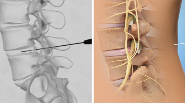 Intradiscal Ozone Therapy